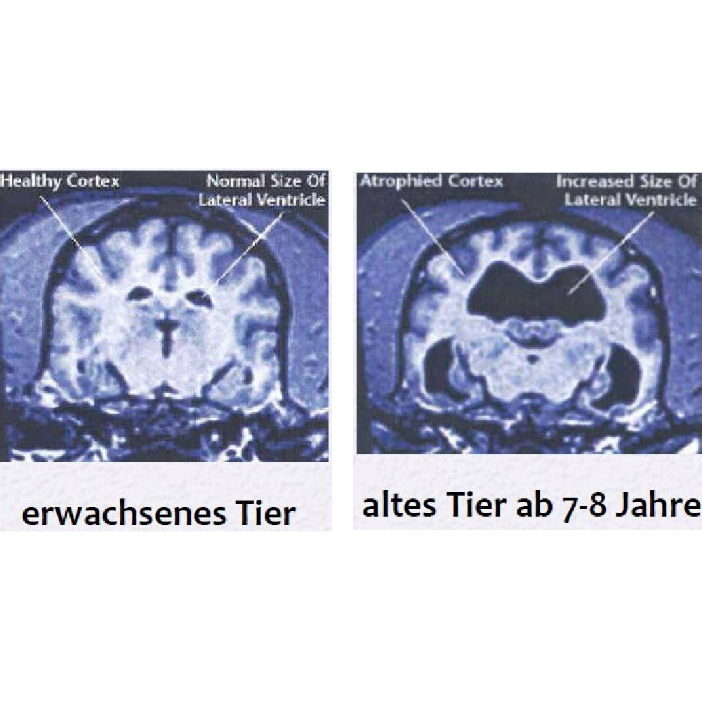 MRI, Gehirn, Scan, Koronar, Gesundheit vs Atrophie